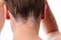 Læsø Shampoo som Psoriasis behandling
