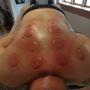 Cupping