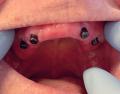 Implantater-til-protese
