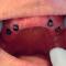 Implantater-til-protese